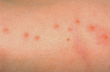 bed-bug-bites